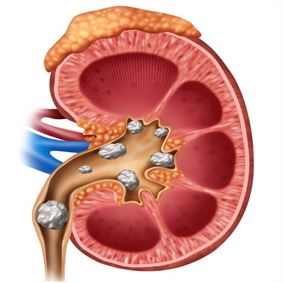 Kidney Stone | Homoeopathic Clinic | Palasia,indore