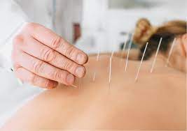 Dry Needling Therapy | Dr. Medha's Physiotherapy And Rehab Clinic, Pimple Saudagar | No - 4, SAI VAASTU, Society, Seven Star Ln, Opposite Ganesham Society, Near Govind Yashada Chowk, Mithila Nagari, Pimple Saudagar, Pune, Pimpri-Chinchwad, Maharashtra 411027, India