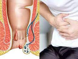 फिस्टुला | Patidar Clinic | 15, Gpo Road, Near Patel Pharma, Opposite Of Get Well Hospital, Katju Nagar, Laxman Pura, Ratlam, Madhya Pradesh 457001