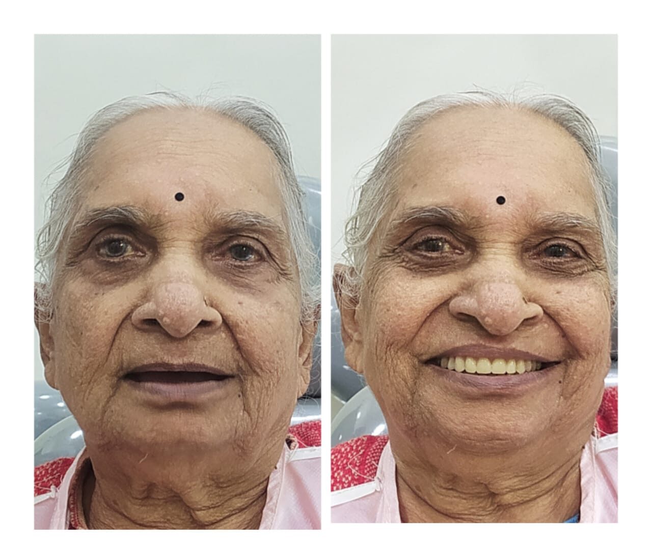 Complete Dentures | Sun Dental | Shiv-pushp Landmark, 1st Floor, Shiv Pushp Chowk, Suncity Lane, Sinhagad Road, Anand Nagar, Pune