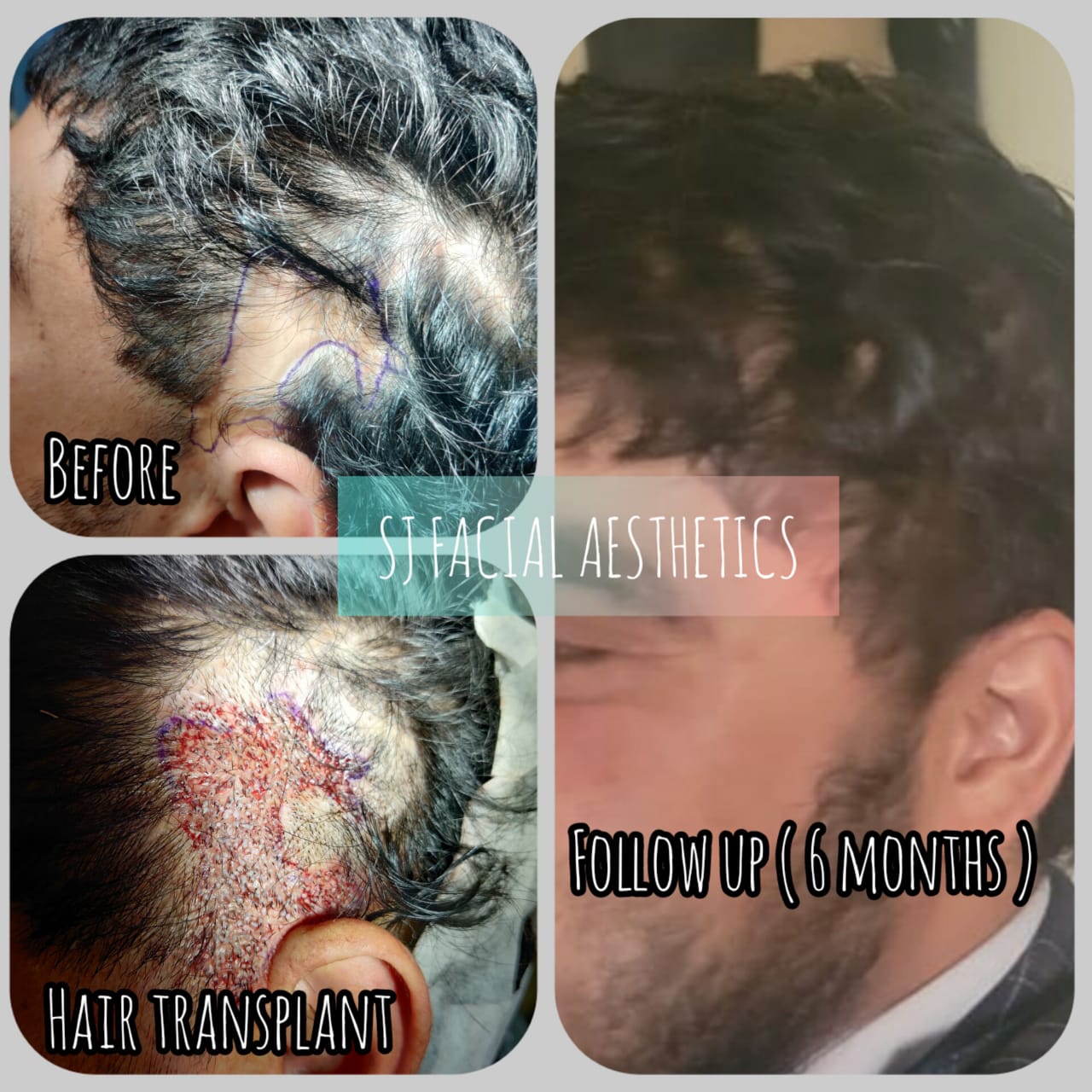 Expert Hair Transplants at Sun Dental | Sun Dental | Shiv-pushp Landmark, 1st Floor, Shiv Pushp Chowk, Suncity Lane, Sinhagad Road, Anand Nagar, Pune