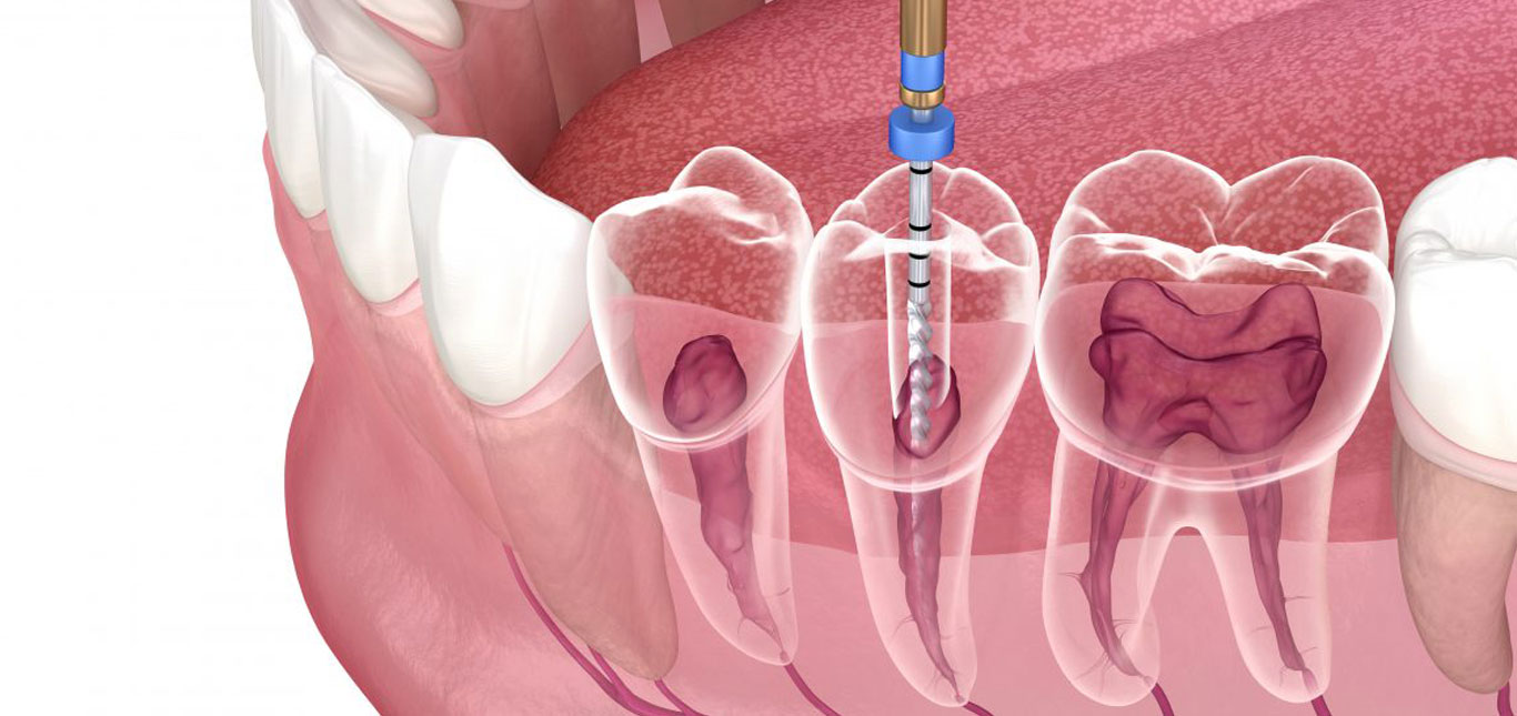 Root canal treatment ( Microscopic/ Single sitting / 3D Obturation with laser surgery - Robotics) My Family Dentist Dental Implant Center (MFD-HARIDWAR) Haridwar, Uttarakhand 249403, India