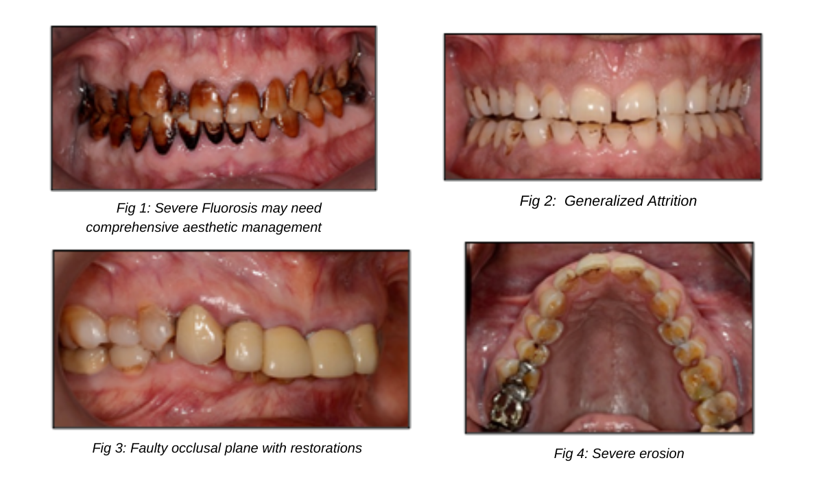 Full Mouth Rehabilitation My Family Dentist Dental Implant Center (MFD-HARIDWAR) Haridwar, Uttarakhand 249403, India