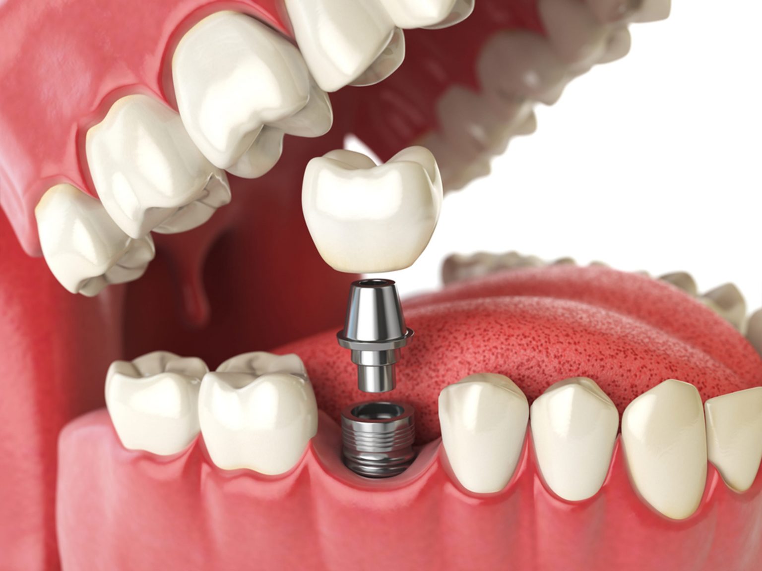 Dental Implant ( fix your teeth only in 72 hrs) My Family Dentist Dental Implant Center (MFD-HARIDWAR) Haridwar, Uttarakhand 249403, India