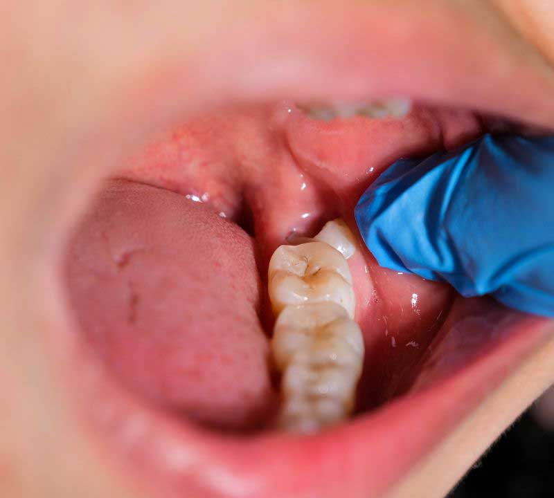 Wisdom tooth removal ( Painless laser surgery) My Family Dentist Dental Implant Center (MFD-HARIDWAR) Haridwar, Uttarakhand 249403, India
