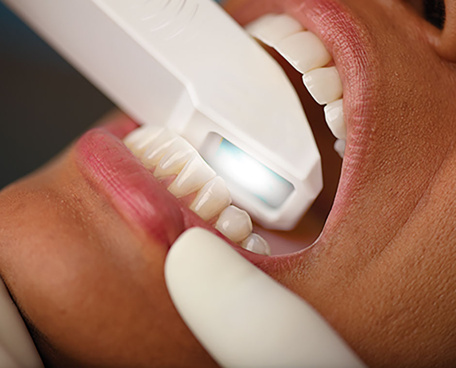 Intra Oral Scanning My Family Dentist Dental Implant Center (MFD-HARIDWAR) Haridwar, Uttarakhand 249403, India