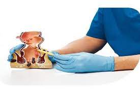 Fistula | Subhash Thakur Clinic | 172 Subhash Thakur Cilinc, Jaora Road, Jaora Phatak, Ratlam - 457001