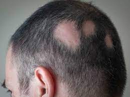 Hair Disease Treatment | Vatsalya Clinic | Narhe