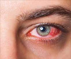 Eye Disorder | Vatsalya Clinic | Narhe