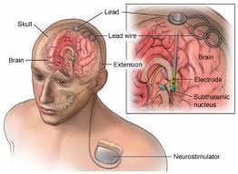 Deep Brain Stimulation (DBS) | Dr. Milesh Nagar | 206, Barbad, Sailana, Road, Opposite Balaji Central Hotel, Near Amrit Garden, Ratlam, Madhya Pradesh 457001