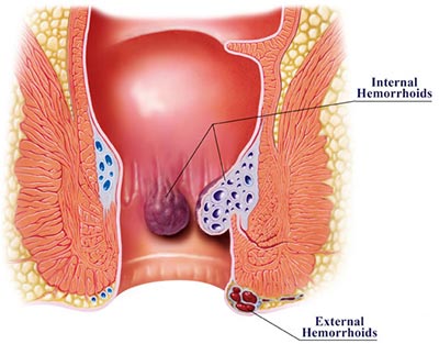 Bleeding Piles AVYAM AYURVEDA Shop No.1, House No.60, B Sector, Airport Rd, Near Spandan Hospital, Indra Vihar Colony, Data Colony, Lalghati, Bhopal, Madhya Pradesh 462030, India