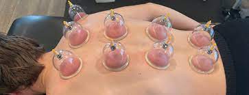 Cupping Therapy | Dr. Meghna's Physiotherapy | B 90 Greater Brajeshwari Piplyahana Behind JMB Sweets Indore