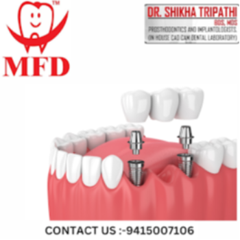 Advance Implant Surgery My Family Dentist Dental Implant Center (MFD-HARIDWAR) Haridwar, Uttarakhand 249403, India