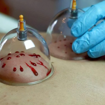 Cupping Centre in Tagore Nagar Raipur (Hijama Therapy) | Nature Acu Health Care Centre | C/137, Tagore Nagar, Raipur, Tikrapara, Chhattisgarh 492001, India