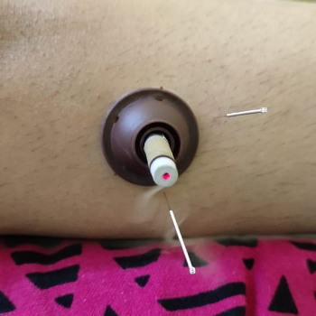 Moksha Therapy | Nature Acu Health Care Centre | C/137, Tagore Nagar, Raipur, Tikrapara, Chhattisgarh 492001, India