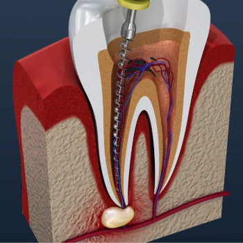 Root Canal Treatment in Vanasthalipuram, Hyderabad | Dr Care Dental Hospital | Dental Clinic | Dentist | H.NO-8-7-91/17/1, SREE HOMES, Nagarjuna Sagar Rd, Padmavathi Nagar, Hasthinapuram South, Hastinapuram,