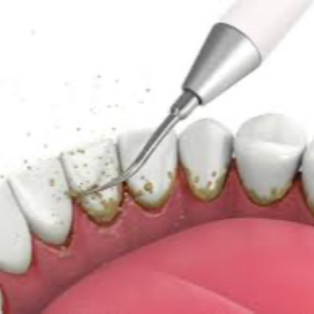 Ultrasonic Scaling in Vanasthalipuram | Dr Care Dental Hospital | Dental Clinic | Dentist | H.NO-8-7-91/17/1, SREE HOMES, Nagarjuna Sagar Rd, Padmavathi Nagar, Hasthinapuram South, Hastinapuram,