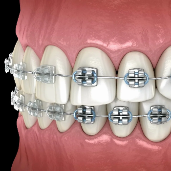 Metal Braces | Dr Care Dental Hospital | Dental Clinic | Dentist | H.NO-8-7-91/17/1, SREE HOMES, Nagarjuna Sagar Rd, Padmavathi Nagar, Hasthinapuram South, Hastinapuram,