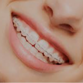Ceramic Braces in Vanasthalipuram | Dr Care Dental Hospital | Dental Clinic | Dentist | H.NO-8-7-91/17/1, SREE HOMES, Nagarjuna Sagar Rd, Padmavathi Nagar, Hasthinapuram South, Hastinapuram,