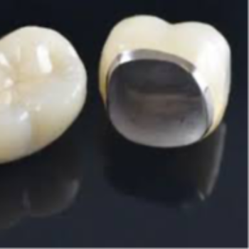 Metal Ceramic Crown in Vanasthalipuram | Dr Care Dental Hospital | Dental Clinic | Dentist | H.NO-8-7-91/17/1, SREE HOMES, Nagarjuna Sagar Rd, Padmavathi Nagar, Hasthinapuram South, Hastinapuram,