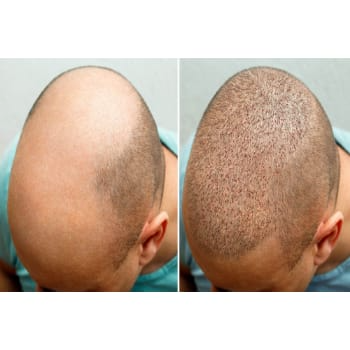 HAIR TRANSPLANTATION 20000 onwards | Shree Sai Clinic | Shop No. 15, Shrirang, ZEAL COLLEGE OF ENGINEERING AND RESEARCH, Chowk, Dhayari Narhe Rd, Narhe, Pune, Maharashtra 411041, India