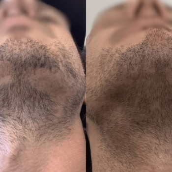 Beard and moustache PRP | Shree Sai Clinic | Shop No. 15, Shrirang, ZEAL COLLEGE OF ENGINEERING AND RESEARCH, Chowk, Dhayari Narhe Rd, Narhe, Pune, Maharashtra 411041, India