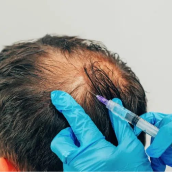 PRP FOR HAIR REGROWTH | Shree Sai Clinic | Shop No. 15, Shrirang, ZEAL COLLEGE OF ENGINEERING AND RESEARCH, Chowk, Dhayari Narhe Rd, Narhe, Pune, Maharashtra 411041, India