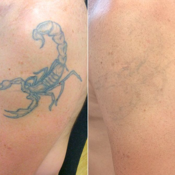 TATTOO REMOVAL 4000 onwards | Shree Sai Clinic | Shop No. 15, Shrirang, ZEAL COLLEGE OF ENGINEERING AND RESEARCH, Chowk, Dhayari Narhe Rd, Narhe, Pune, Maharashtra 411041, India