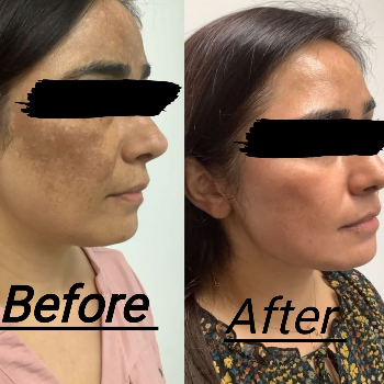 PIGMENTATION TREATMENT | Shree Sai Clinic | Shop No. 15, Shrirang, ZEAL COLLEGE OF ENGINEERING AND RESEARCH, Chowk, Dhayari Narhe Rd, Narhe, Pune, Maharashtra 411041, India