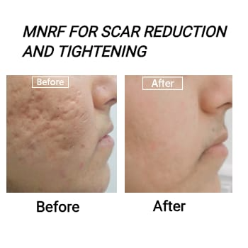 MNRF FOR SCAR AND TIGHTENING | Shree Sai Clinic | Shop No. 15, Shrirang, ZEAL COLLEGE OF ENGINEERING AND RESEARCH, Chowk, Dhayari Narhe Rd, Narhe, Pune, Maharashtra 411041, India