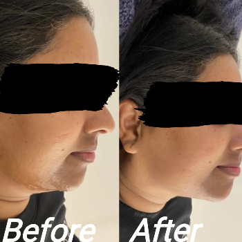 HIFU FOR TIGHTENING | Shree Sai Clinic | Shop No. 15, Shrirang, ZEAL COLLEGE OF ENGINEERING AND RESEARCH, Chowk, Dhayari Narhe Rd, Narhe, Pune, Maharashtra 411041, India