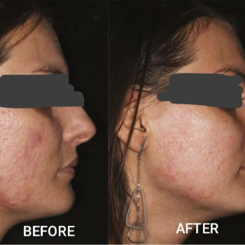 PIMPLES / ACNE TREATMENT | Shree Sai Clinic | Shop No. 15, Shrirang, ZEAL COLLEGE OF ENGINEERING AND RESEARCH, Chowk, Dhayari Narhe Rd, Narhe, Pune, Maharashtra 411041, India