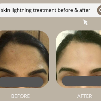 SKIN WHITENING TREATMENT ₹1000/- ONWARDS | Shree Sai Clinic | Shop No. 15, Shrirang, ZEAL COLLEGE OF ENGINEERING AND RESEARCH, Chowk, Dhayari Narhe Rd, Narhe, Pune, Maharashtra 411041, India