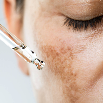 PIGMENTATION TREATMENT ₹1000/- ONWARDS | Shree Sai Clinic | Shop No. 15, Shrirang, ZEAL COLLEGE OF ENGINEERING AND RESEARCH, Chowk, Dhayari Narhe Rd, Narhe, Pune, Maharashtra 411041, India