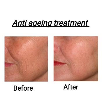 ANTI AGEING TREATMENT ₹1000/- ONWARDS | Shree Sai Clinic | Shop No. 15, Shrirang, ZEAL COLLEGE OF ENGINEERING AND RESEARCH, Chowk, Dhayari Narhe Rd, Narhe, Pune, Maharashtra 411041, India
