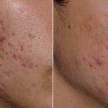 ACNE SCAR TREATMENT ₹4000/- ONWARDS | Shree Sai Clinic | Shop No. 15, Shrirang, ZEAL COLLEGE OF ENGINEERING AND RESEARCH, Chowk, Dhayari Narhe Rd, Narhe, Pune, Maharashtra 411041, India