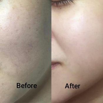 Korean Glass Facial Treatment in Narhe, Pune | Shree Sai Clinic | Shree Sai Clinic | Shop No. 15, Shrirang, ZEAL COLLEGE OF ENGINEERING AND RESEARCH, Chowk, Dhayari Narhe Rd, Narhe, Pune, Maharashtra 411041, India