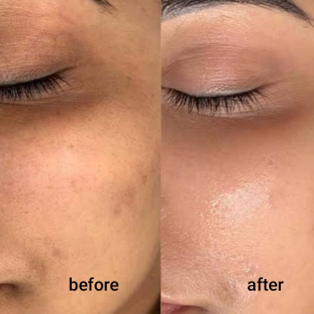 BB Glow Treatment in Pune | Shree Sai Clinic | Shree Sai Clinic | Shop No. 15, Shrirang, ZEAL COLLEGE OF ENGINEERING AND RESEARCH, Chowk, Dhayari Narhe Rd, Narhe, Pune, Maharashtra 411041, India