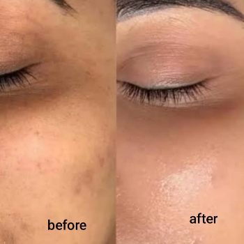 CC GLOW TREATMENT | Shree Sai Clinic | Shop No. 15, Shrirang, ZEAL COLLEGE OF ENGINEERING AND RESEARCH, Chowk, Dhayari Narhe Rd, Narhe, Pune, Maharashtra 411041, India