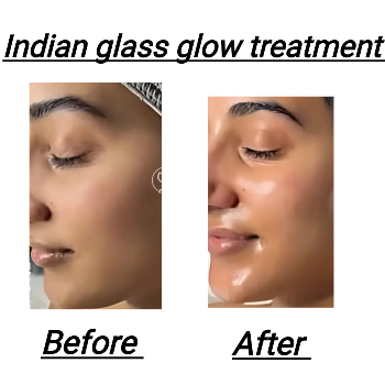 INDIAN GLASS GLOW TREATMENT | Shree Sai Clinic | Shop No. 15, Shrirang, ZEAL COLLEGE OF ENGINEERING AND RESEARCH, Chowk, Dhayari Narhe Rd, Narhe, Pune, Maharashtra 411041, India