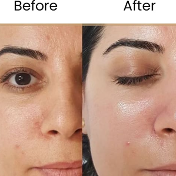 WHITENING COCKTAILS TREATMENT | Shree Sai Clinic | Shop No. 15, Shrirang, ZEAL COLLEGE OF ENGINEERING AND RESEARCH, Chowk, Dhayari Narhe Rd, Narhe, Pune, Maharashtra 411041, India