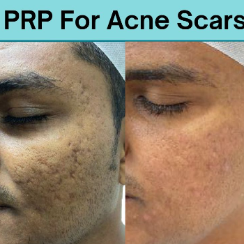 FACE PRP TREATMENT | Shree Sai Clinic | Shop No. 15, Shrirang, ZEAL COLLEGE OF ENGINEERING AND RESEARCH, Chowk, Dhayari Narhe Rd, Narhe, Pune, Maharashtra 411041, India