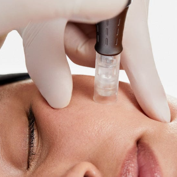 Microneedling Treatment in Narhe, Pune | Shree Sai Clinic | Shree Sai Clinic | Shop No. 15, Shrirang, ZEAL COLLEGE OF ENGINEERING AND RESEARCH, Chowk, Dhayari Narhe Rd, Narhe, Pune, Maharashtra 411041, India