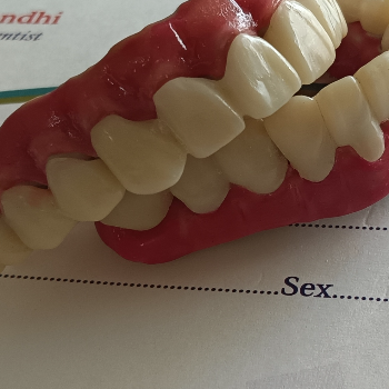 Metal Ceramic Crown In Hasthinapuram | Dr Care Dental Hospital | Dental Clinic | Dentist | H.NO-8-7-91/17/1, SREE HOMES, Nagarjuna Sagar Rd, Padmavathi Nagar, Hasthinapuram South, Hastinapuram,