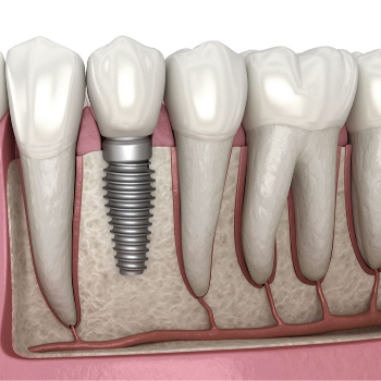 Dental Implant In Hasthinapuram | Dr Care Dental Hospital | Dental Clinic | Dentist | H.NO-8-7-91/17/1, SREE HOMES, Nagarjuna Sagar Rd, Padmavathi Nagar, Hasthinapuram South, Hastinapuram,