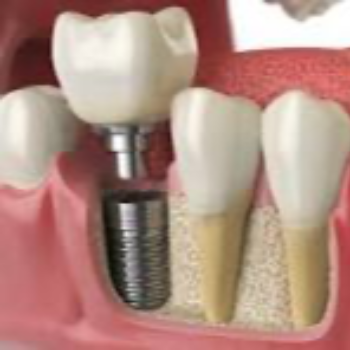 Dental Implant In Nagole | Dr Care Dental Hospital | Dental Clinic | Dentist | H.NO-8-7-91/17/1, SREE HOMES, Nagarjuna Sagar Rd, Padmavathi Nagar, Hasthinapuram South, Hastinapuram,