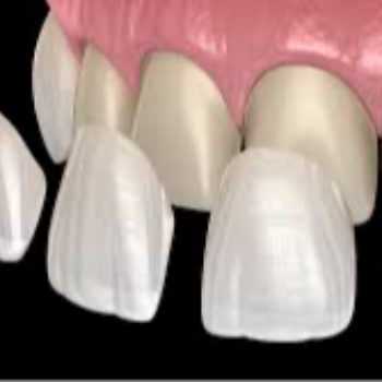 Dental Veneers In Vanasthalipuram | Dr Care Dental Hospital | Dental Clinic | Dentist | H.NO-8-7-91/17/1, SREE HOMES, Nagarjuna Sagar Rd, Padmavathi Nagar, Hasthinapuram South, Hastinapuram,