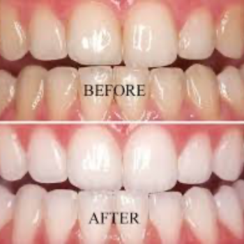 Teeth Whitening At Vanasthalipuram | Dr Care Dental Hospital | Dental Clinic | Dentist | H.NO-8-7-91/17/1, SREE HOMES, Nagarjuna Sagar Rd, Padmavathi Nagar, Hasthinapuram South, Hastinapuram,