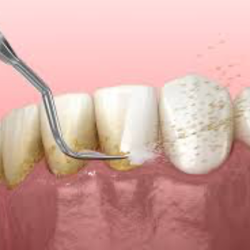 Teeth Cleaning At Vanasthalipuram | Dr Care Dental Hospital | Dental Clinic | Dentist | H.NO-8-7-91/17/1, SREE HOMES, Nagarjuna Sagar Rd, Padmavathi Nagar, Hasthinapuram South, Hastinapuram,