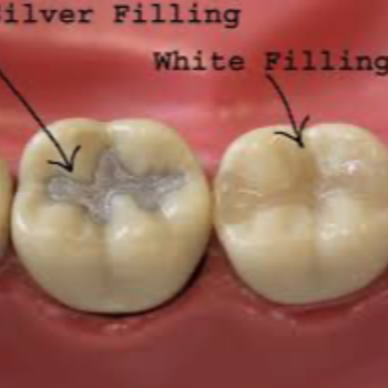 Dental Filling At Vanasthalipuram | Dr Care Dental Hospital | Dental Clinic | Dentist | H.NO-8-7-91/17/1, SREE HOMES, Nagarjuna Sagar Rd, Padmavathi Nagar, Hasthinapuram South, Hastinapuram,